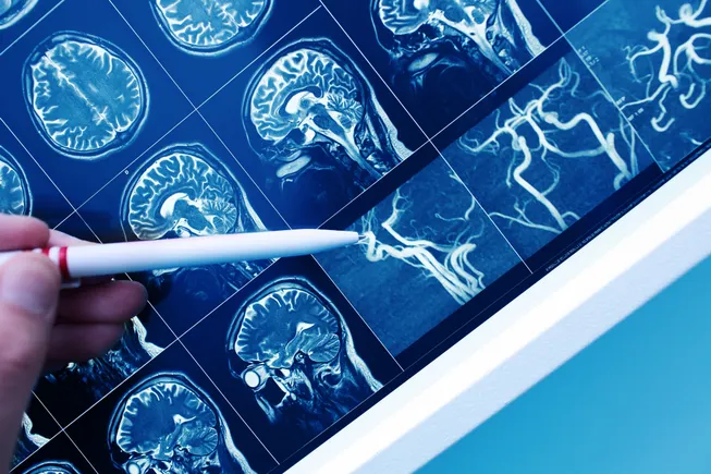 Gain Therapeutics navigates financing hurdles as it advances novel GBA-1 targeted Parkinson's candidate